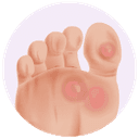 Corns/Calluses