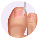 Toenail Restoration